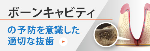 ボーンキャビティの予防を意識した適切な抜歯