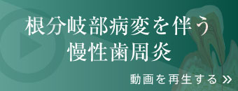 根分岐部病変を伴う慢性歯周炎 動画を再生する