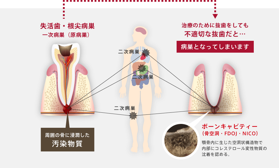 失活歯・根尖病巣一次病巣（原病巣） 治療のために抜歯をしても不適切な抜歯だと…病巣となってしまいます ボーンキャビティー（骨空洞・FDOJ・NICO） 顎骨内に生じた空洞状構造物で内部にコレステロール変性物質の沈着を認める。