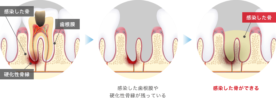 通常の抜歯