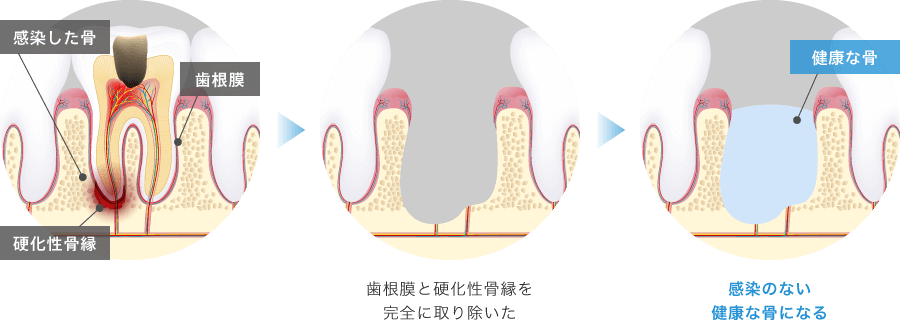 ボーンキャビティの予防を意識した適切な抜歯