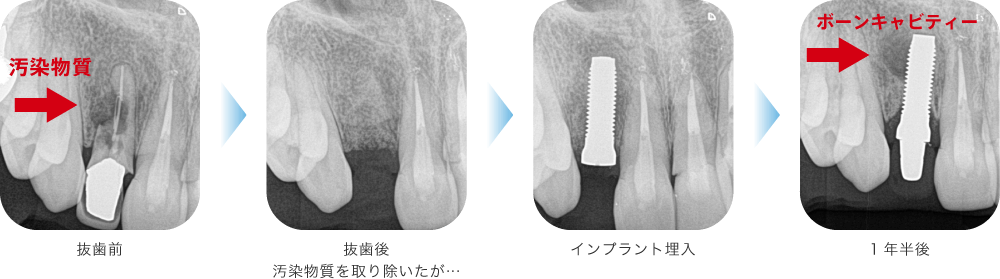 通常の抜歯