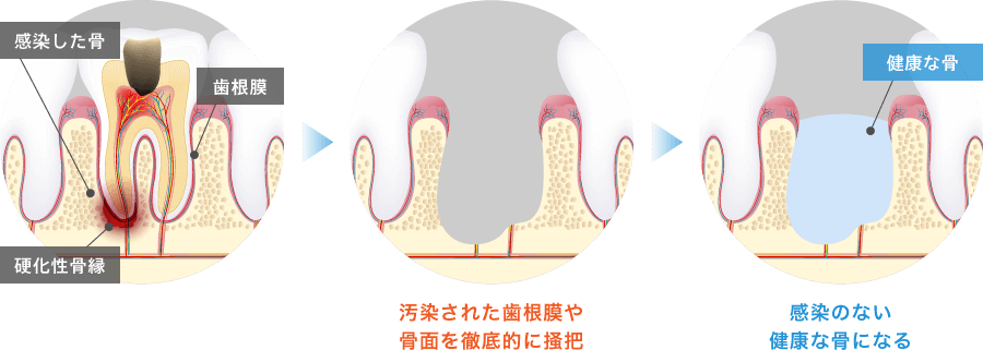 通常の抜歯