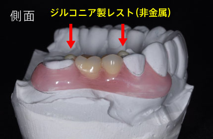側面/ジルコニア製レスト（非金属）
