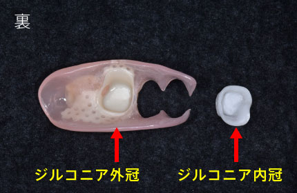 裏/ジルコニア外冠、ジルコニア内冠