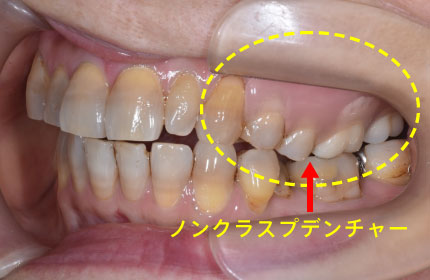 ノンクラスプデンチャー