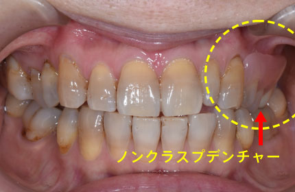 ノンクラスプデンチャー