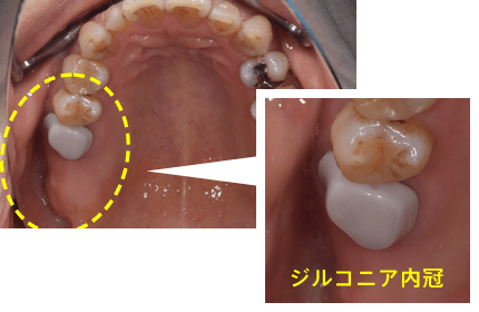 ジルコニア内冠