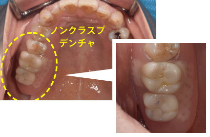 ノンクラスプデンチャ