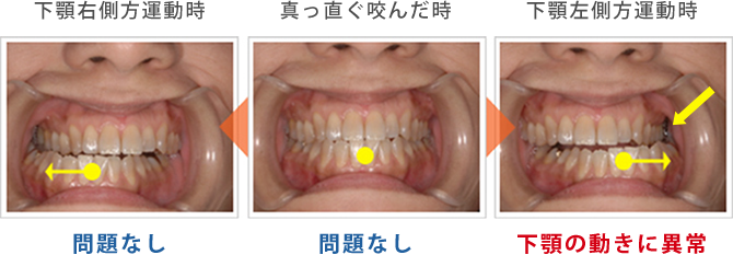 下顎右側方運動時 問題なし 真っ直ぐ咬んだ時 問題なし 下顎左側方運動時 下顎の動きに異常