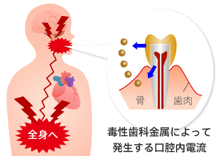 毒性歯科金属によって発生する口腔内電流