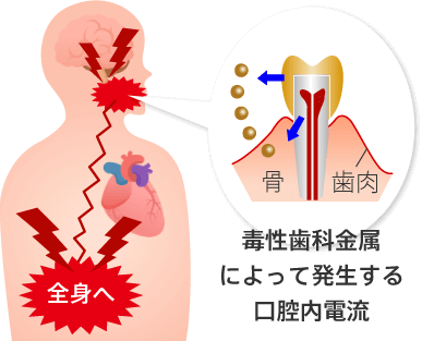 毒性歯科金属によって発生する口腔内電流