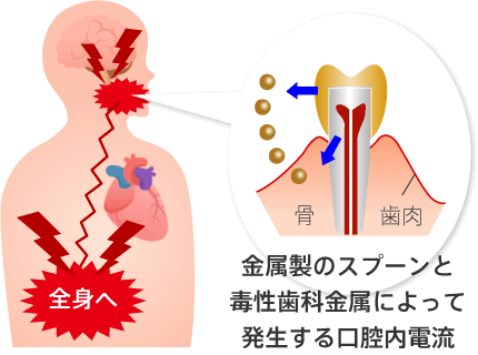 金属製のスプーンと毒性歯科金属によって発生する口腔内電流
