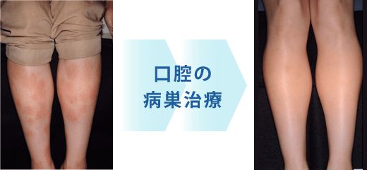 身の回りの電磁波を歯科金属が集積します