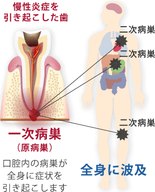 慢性炎症を引き起こした歯 一次病巣（原病巣） 口腔内の病巣が全身に症状を引き起こします 全身に波及