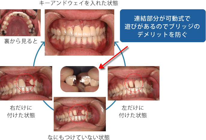 連結部分が可動式で遊びがあるのでデメリットを防ぐ