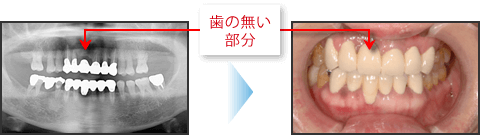 歯の無い部分