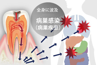 病巣疾患（病巣感染）