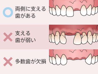 両側に支える歯がある/支える歯が弱い/多数歯が欠損