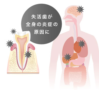 失活歯が全身の炎症の原因に