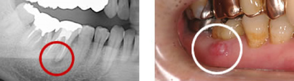 歯科金属を外すと金属の下に虫歯があります