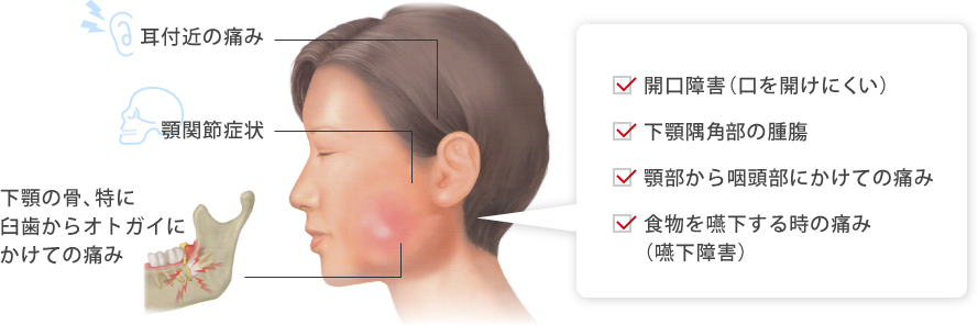 下顎の骨、特に臼歯からオトガイにかけての痛み 耳付近の痛み 顎関節症状 開口障害（口を開けにくい） 下顎隅角部の腫膓 顎部から咽頭部にかけての痛み 食物を嚥下する時の痛み（嚥下障害）