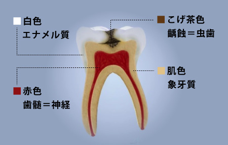 虫歯が神経に達していない