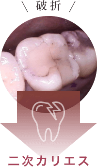 二次カリエス